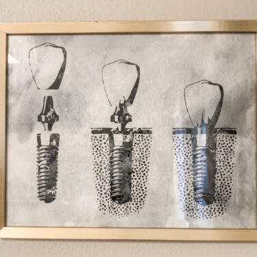 Dental Implants Image at Dental Office