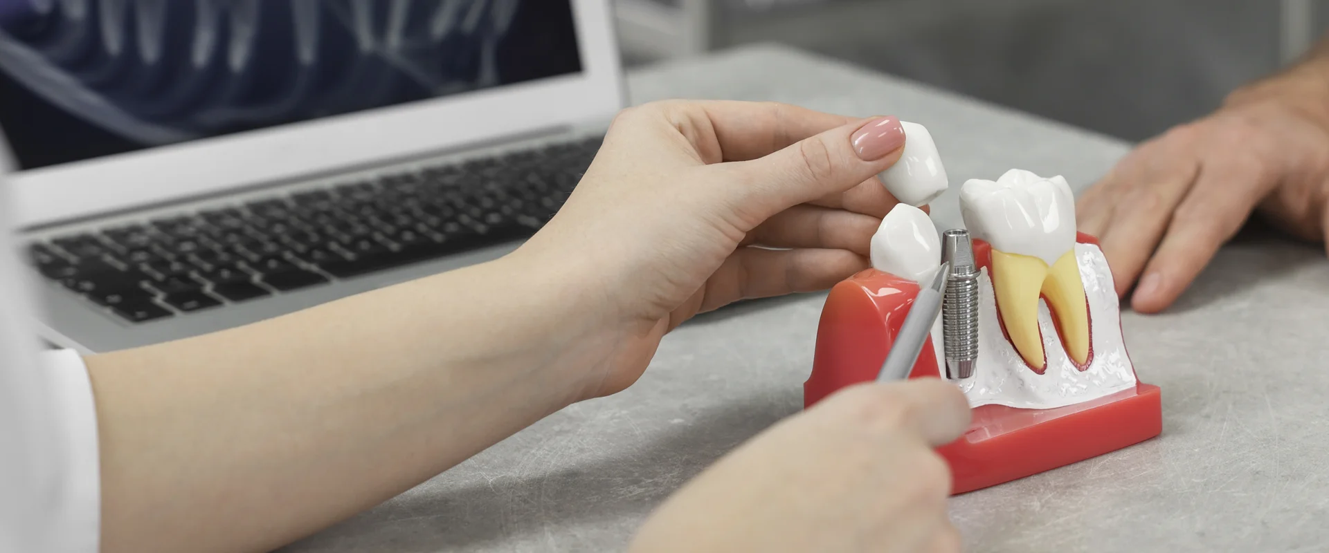 $1000 off on Implants