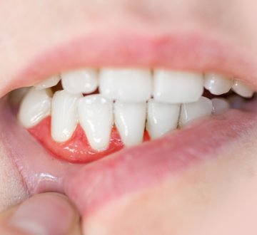 How to Deal with a Chipped Tooth at Gum Line and No Pain?