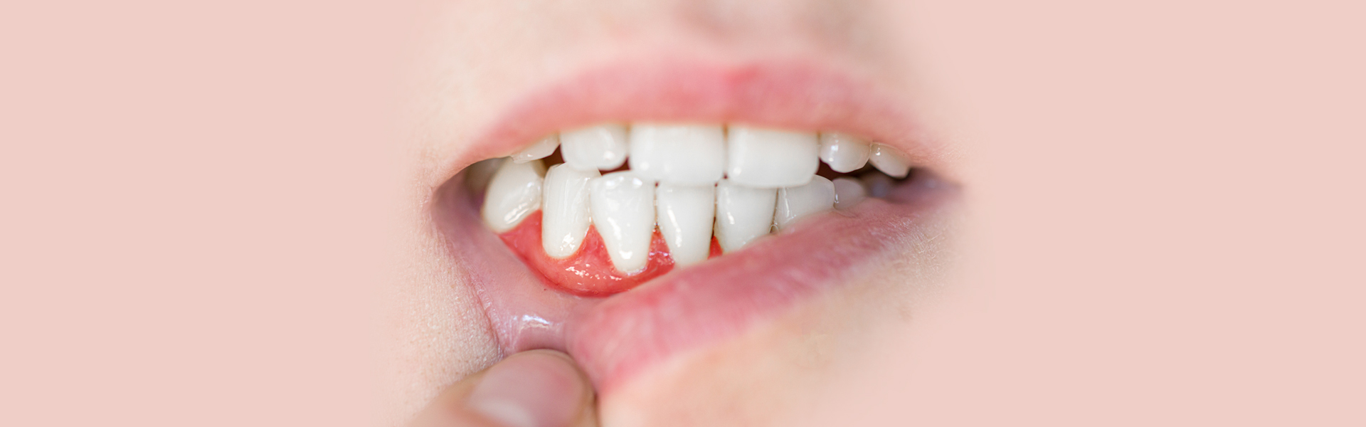 How to Deal with a Chipped Tooth at Gum Line and No Pain?