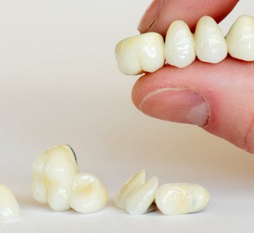 Second Root Canal on the Same Tooth with a Crown
